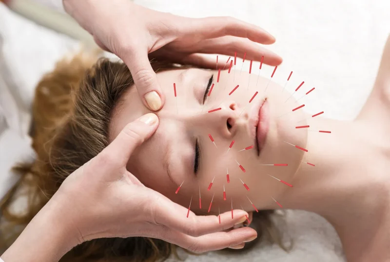 Acupuncture-insertion-needles-skin-points-body-tissues